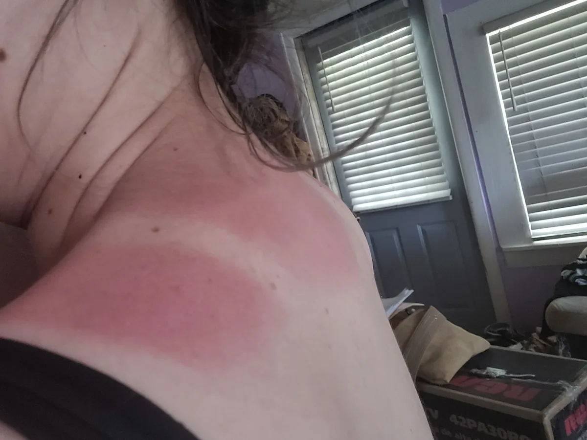 A close-up photo shows a person's bare shoulder and upper back with a large, reddened area, likely from sunburn. The…