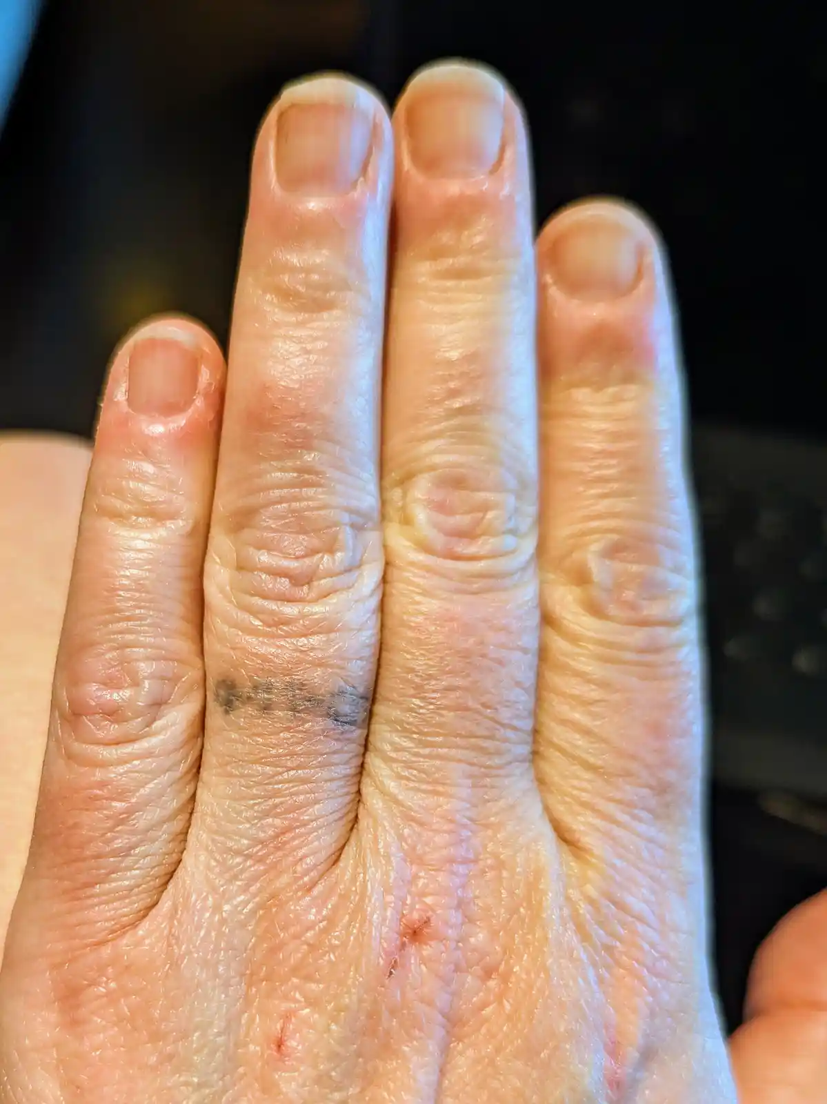 A close-up photo shows a person's hand with visible skin texture and minor cuts on the palm. A small, faded tattoo is…