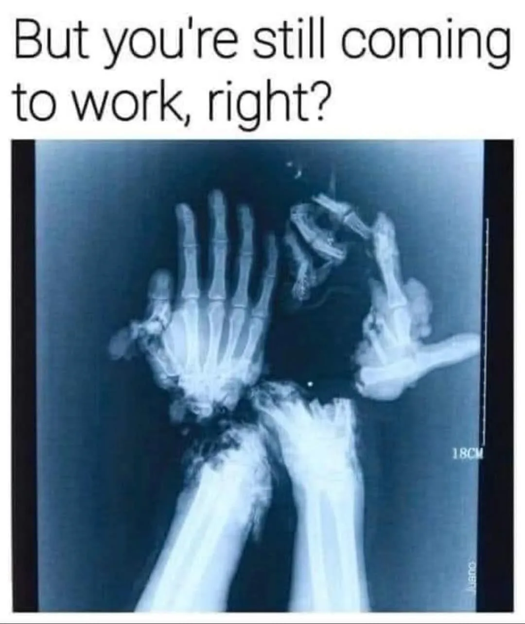 An x-ray image shows a person's hands and wrists with severe fractures and dislocations, including a visibly broken and…