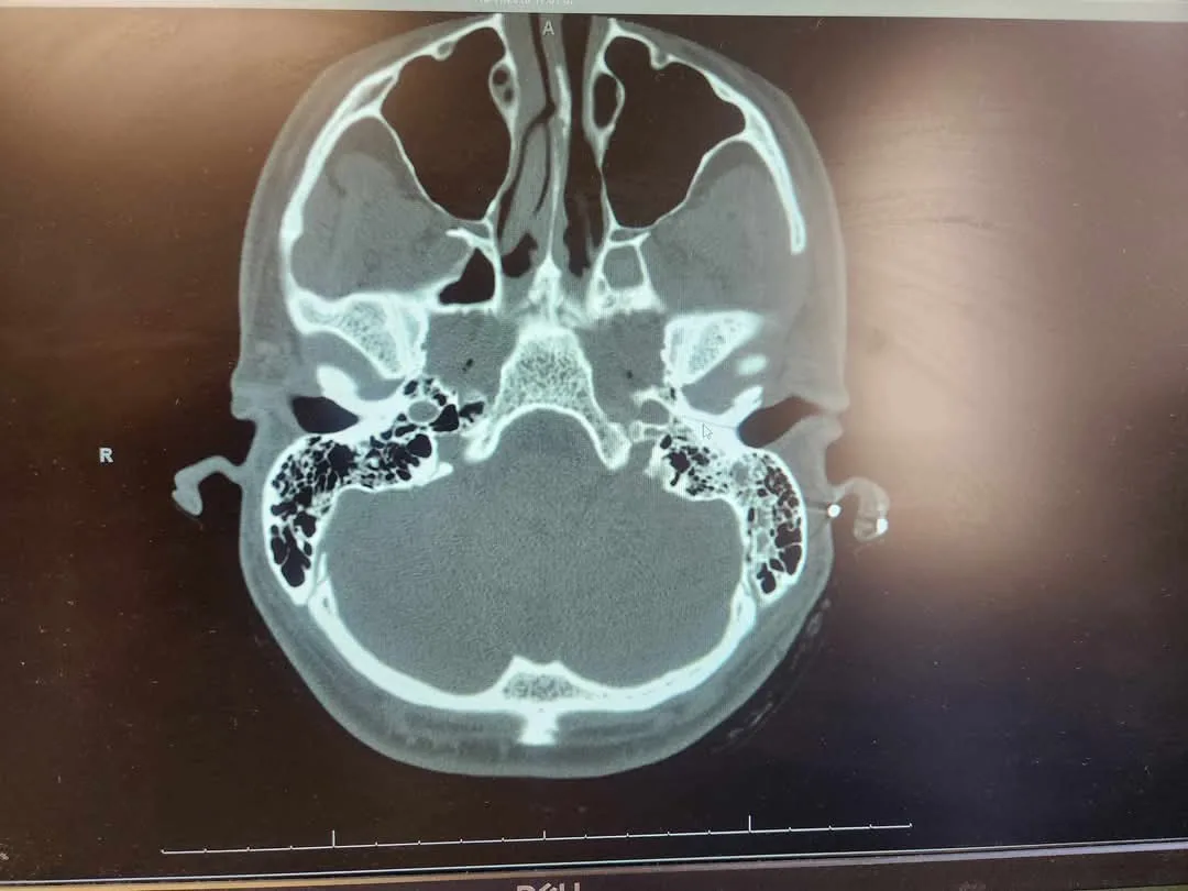A medical CT scan image of a human skull cross-section showing the sinuses and brain cavity, with dark, irregularly shaped…